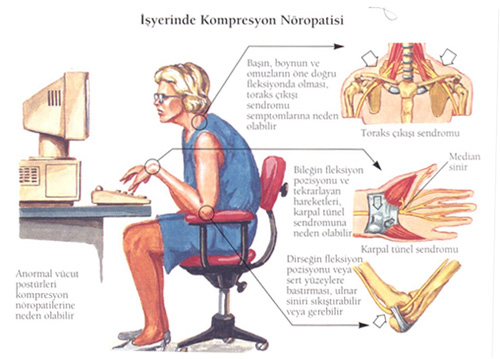 Bad Posture and Back Pain » The BioMechanics Method